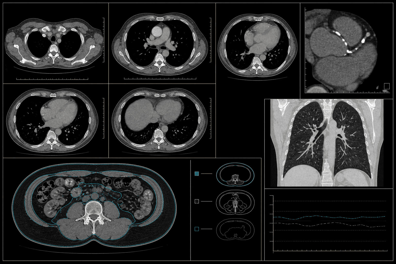 Illustrative non-contrast CT data workstation